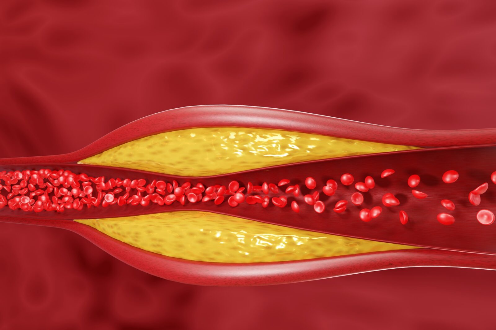 Arterienverkalkung Gefäßreinignug auf natürliche Weise - Titel BellsWelt